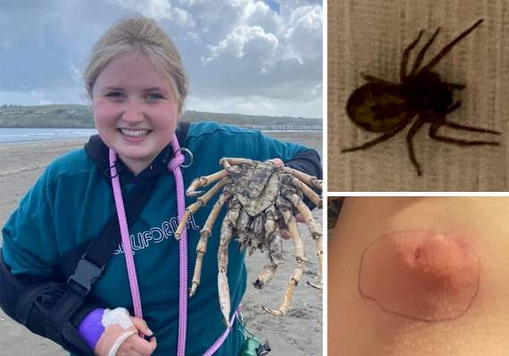 WalesOnline - A spider bite is set to change the life of a