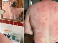 Mid Wales man survives more than 160 wasp stings