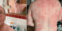 Mid Wales man survives more than 160 wasp stings