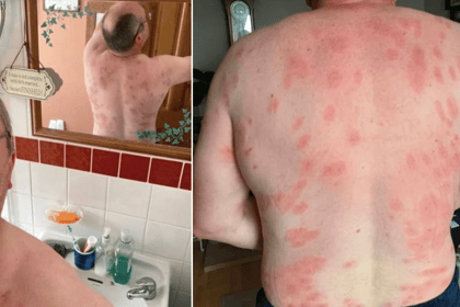 Mid Wales man survives more than 160 wasp stings