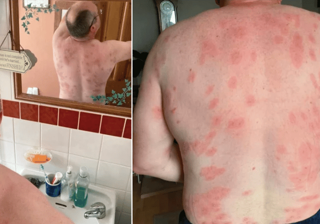 Mid Wales man survives more than 160 wasp stings