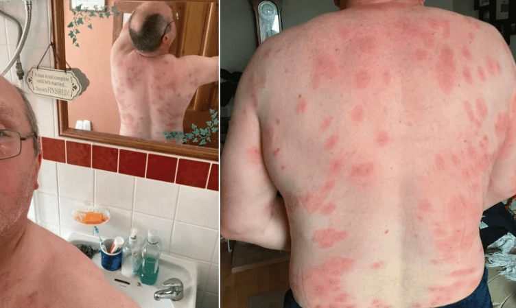 Andrew Powell 160+ wasp stings